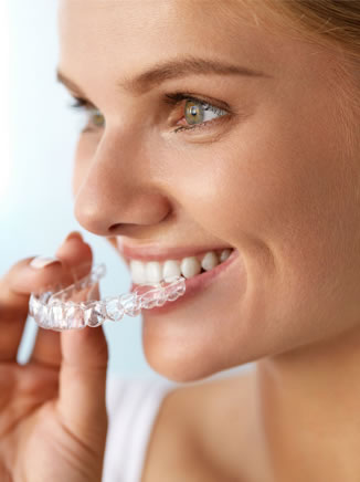 clear aligners